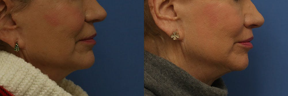 Lip Lift Before & After Gallery - Patient 204424 - Image 3