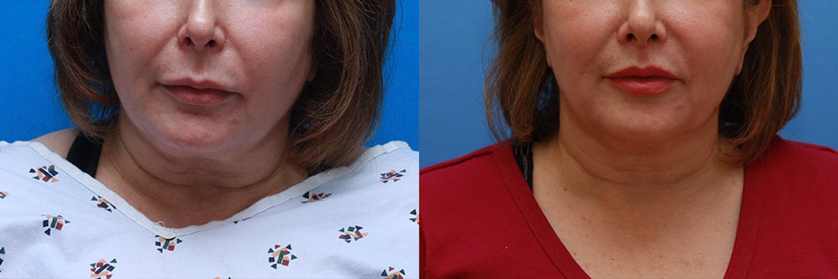 Lip Lift Before & After Gallery - Patient 385117 - Image 1