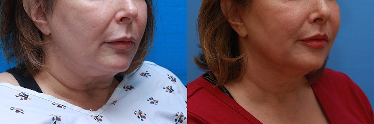 Lip Lift Before & After Gallery - Patient 385117 - Image 2