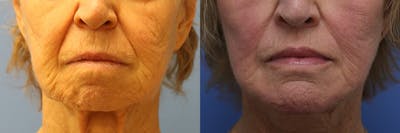 Lip Lift Before & After Gallery - Patient 103465 - Image 1