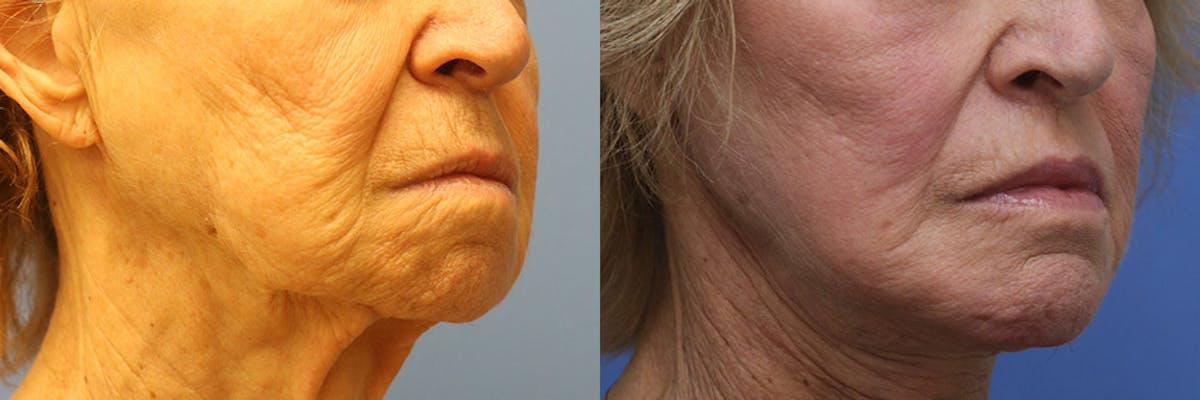 Lip Lift Before & After Gallery - Patient 103465 - Image 2