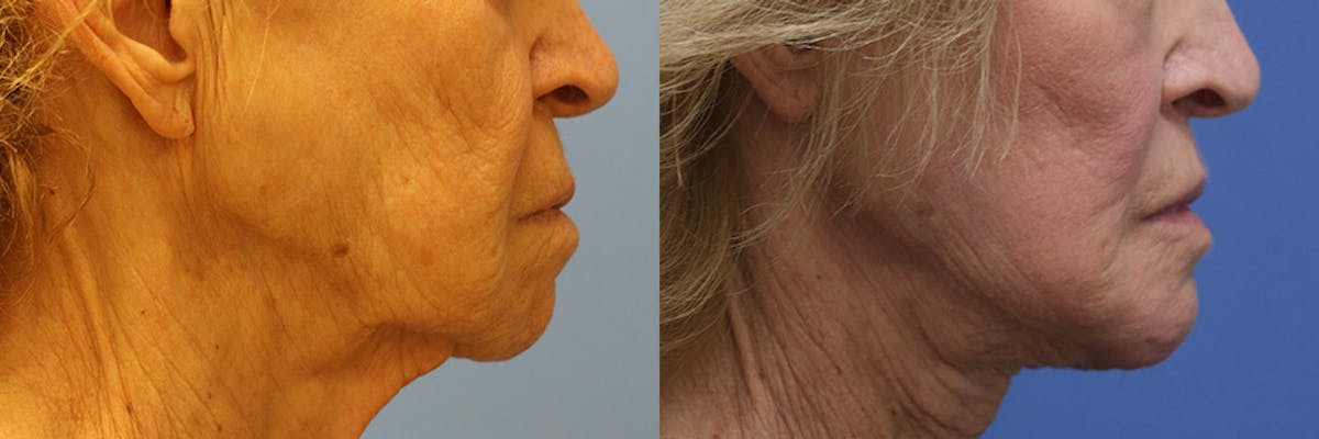 Lip Lift Before & After Gallery - Patient 103465 - Image 3