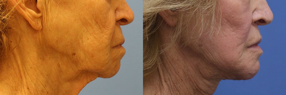 Lip Lift Before & After Gallery - Patient 103465 - Image 3