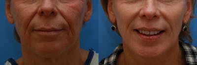 Lip Lift Before & After Gallery - Patient 624841 - Image 1