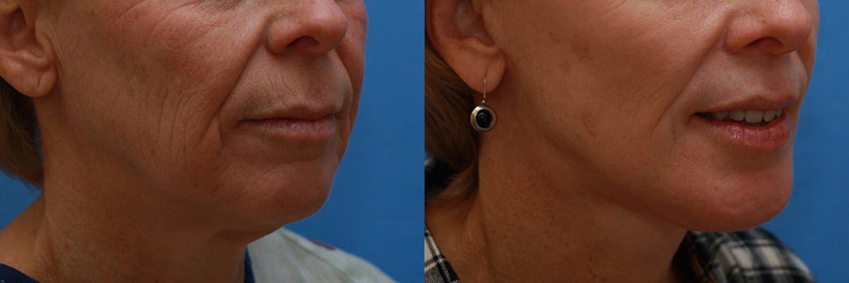 Lip Lift Before & After Gallery - Patient 624841 - Image 2