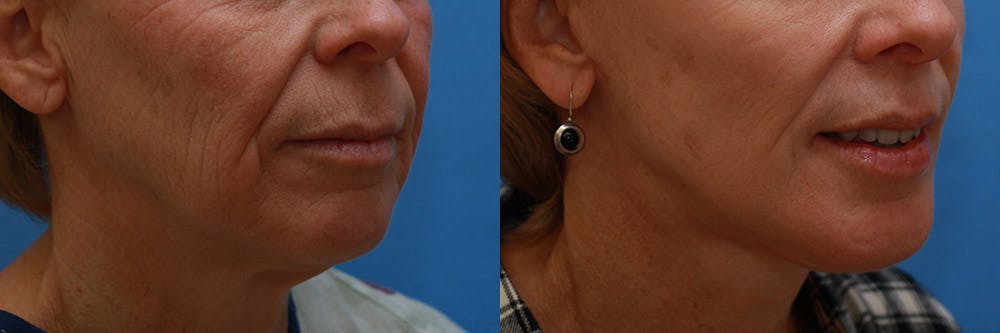 Lip Lift Before & After Gallery - Patient 624841 - Image 2