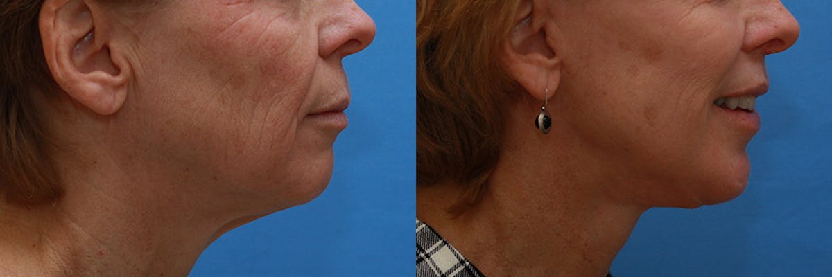 Lip Lift Before & After Gallery - Patient 624841 - Image 3