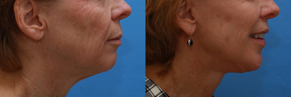 Lip Lift Before & After Gallery - Patient 624841 - Image 3
