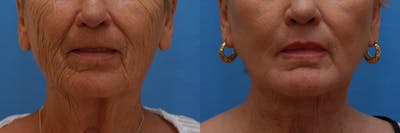 Lip Lift Before & After Gallery - Patient 222971 - Image 1