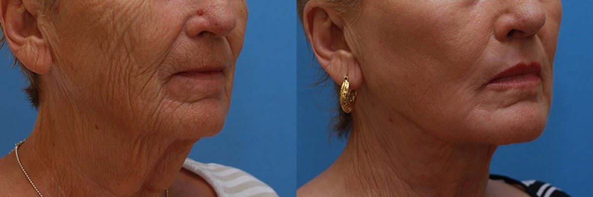 Lip Lift Before & After Gallery - Patient 222971 - Image 2