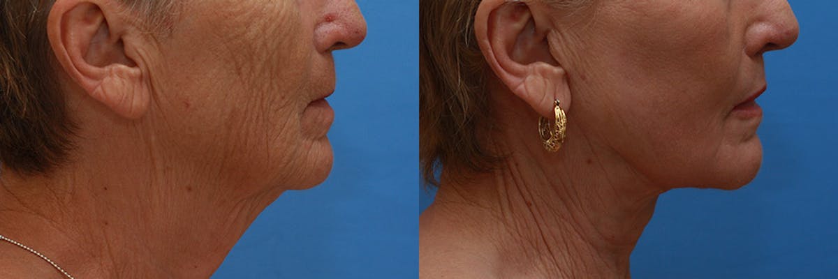 Lip Lift Before & After Gallery - Patient 222971 - Image 3