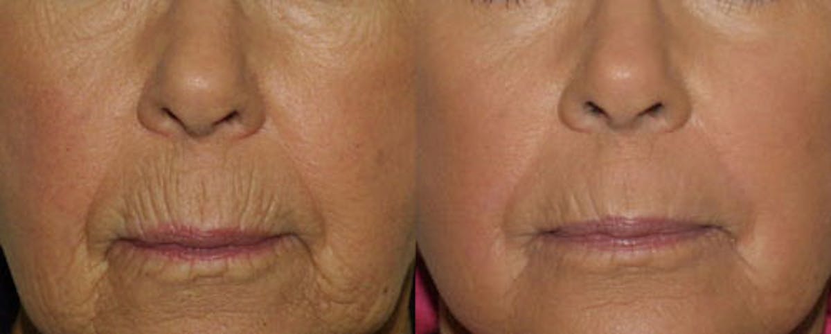Lips Before & After Gallery - Patient 296627 - Image 1