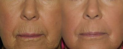 Lips Before & After Gallery - Patient 296627 - Image 1