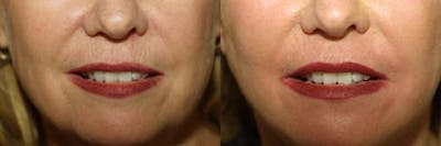 Lips Before & After Gallery - Patient 420012 - Image 1