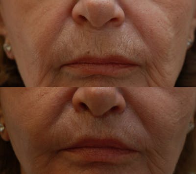 Lips Before & After Gallery - Patient 921770 - Image 1