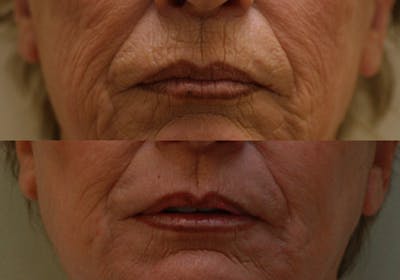 Lips Before & After Gallery - Patient 829371 - Image 1