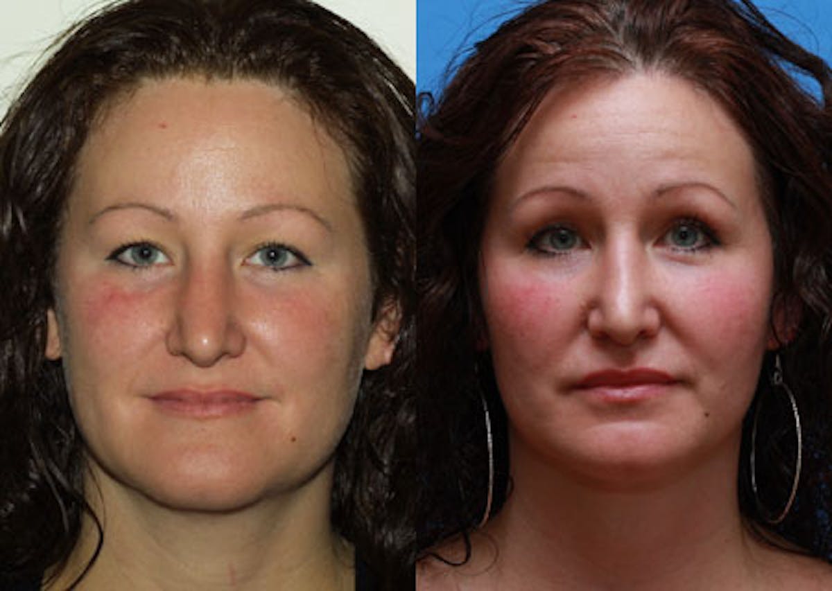 Lips Before & After Gallery - Patient 397413 - Image 1