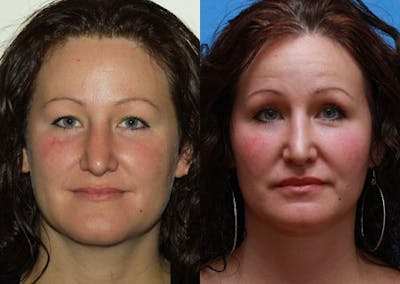 Lips Before & After Gallery - Patient 397413 - Image 1