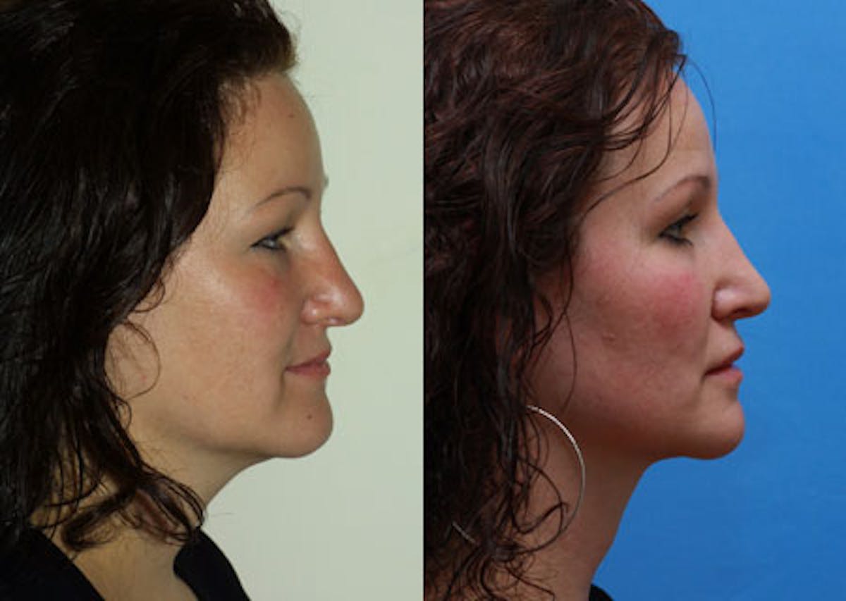 Lips Before & After Gallery - Patient 397413 - Image 2