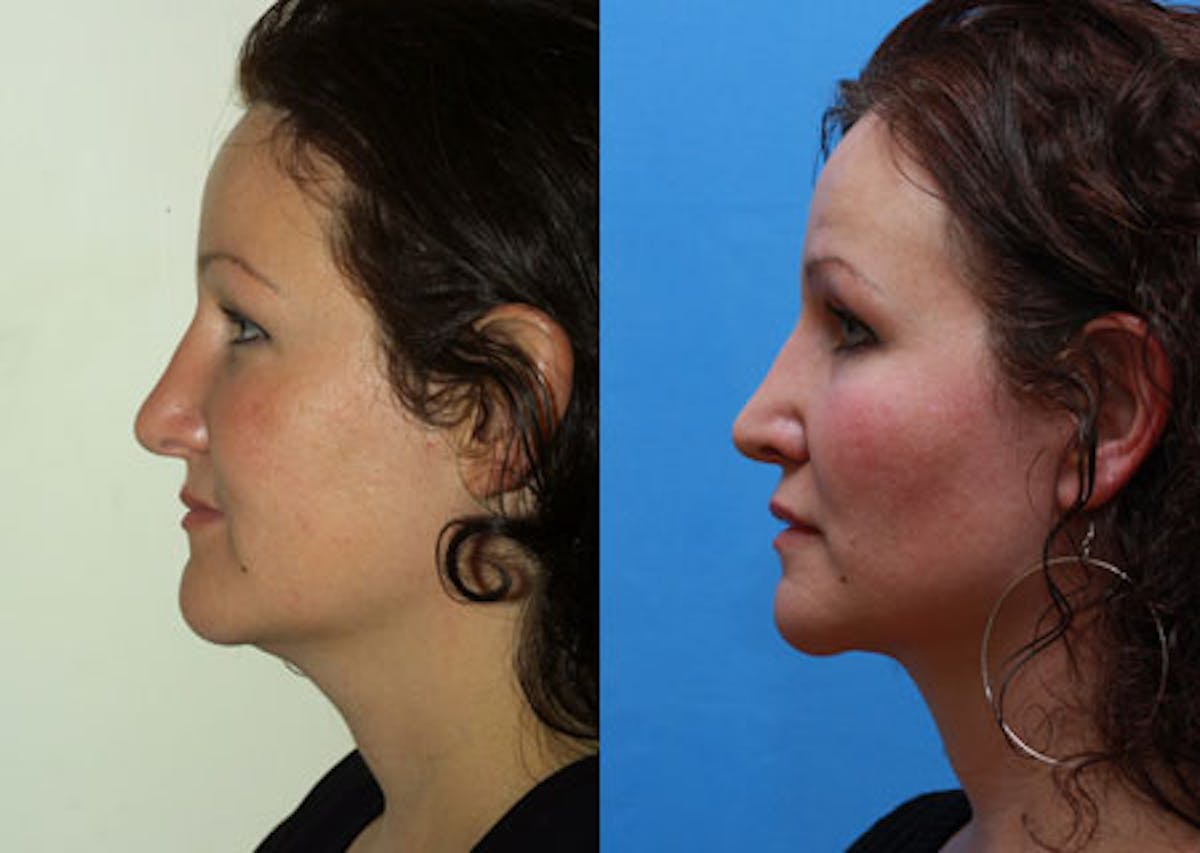 Lips Before & After Gallery - Patient 397413 - Image 3