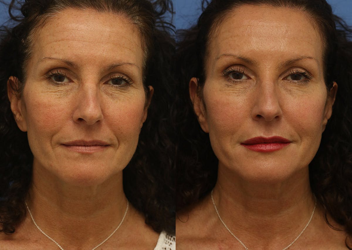 Fillers Before & After Gallery - Patient 307560 - Image 1