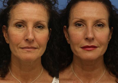 Fillers Before & After Gallery - Patient 307560 - Image 1