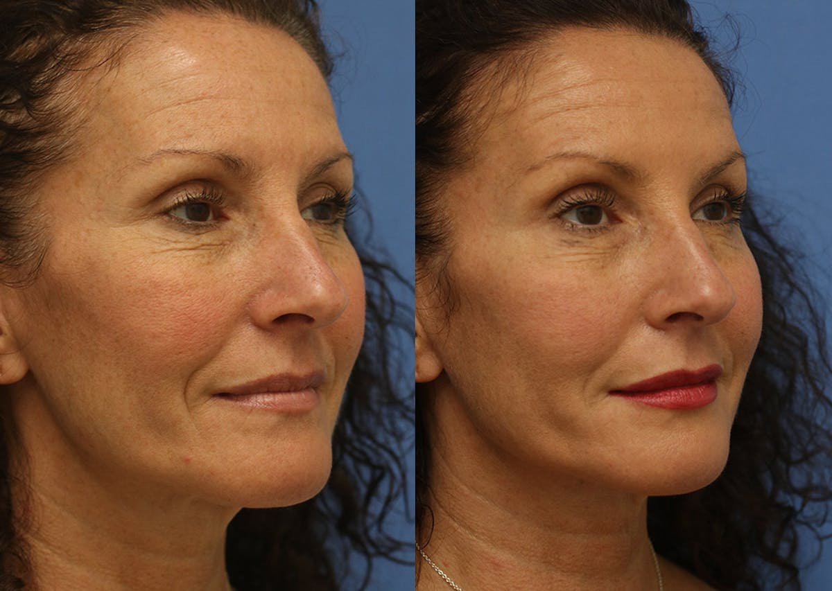 Fillers Before & After Gallery - Patient 307560 - Image 2