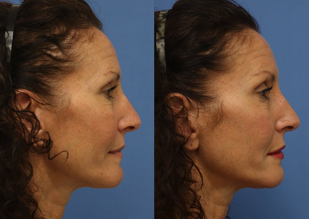 Fillers Before & After Gallery - Patient 307560 - Image 3