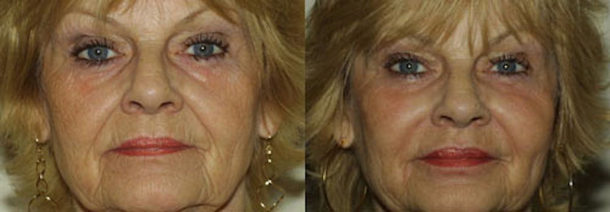 Fillers Before & After Gallery - Patient 180140 - Image 1
