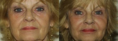 Fillers Before & After Gallery - Patient 180140 - Image 1
