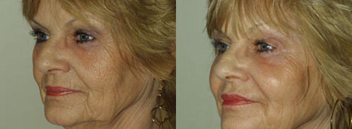 Fillers Before & After Gallery - Patient 180140 - Image 2