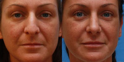 Fillers Before & After Gallery - Patient 292325 - Image 1