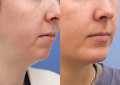 Chin Implants Before & After Gallery - Patient 118776 - Image 1