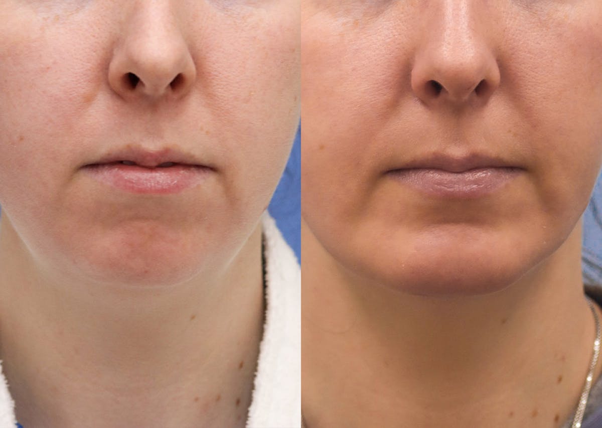Chin Implants Before & After Gallery - Patient 118776 - Image 2