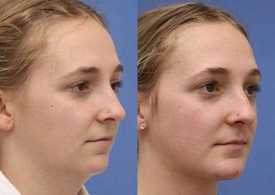 Chin Implants Before & After Gallery - Patient 172863 - Image 1