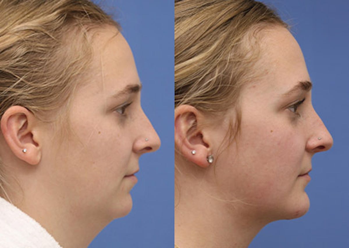 Chin Implants Before & After Gallery - Patient 172863 - Image 2