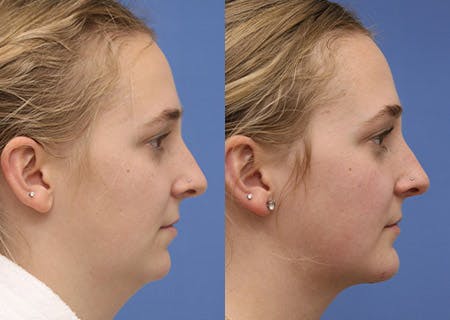 Chin Implants Before & After Gallery - Patient 172863 - Image 2