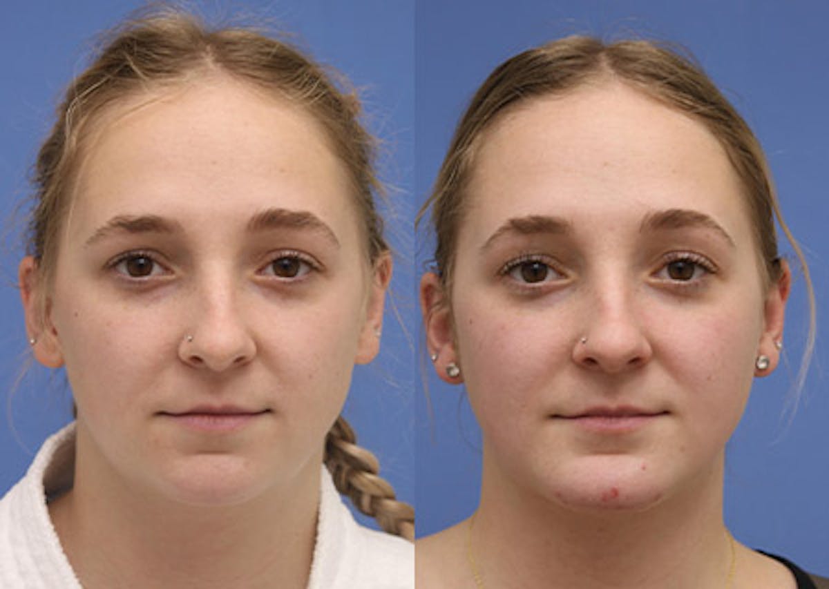 Chin Implants Before & After Gallery - Patient 172863 - Image 3