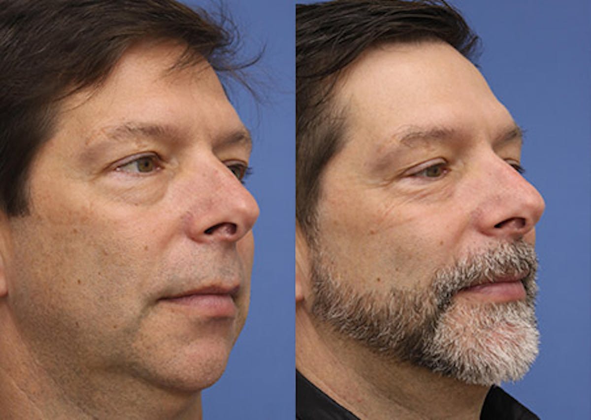 Chin Implants Before & After Gallery - Patient 600767 - Image 1