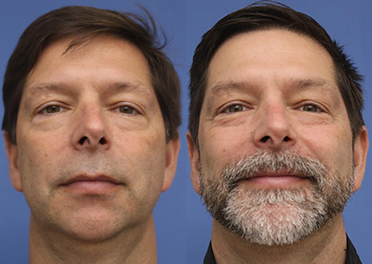 Chin Implants Before & After Gallery - Patient 600767 - Image 3