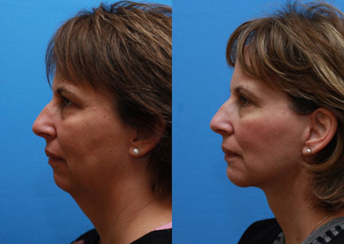 Chin Implants Before & After Gallery - Patient 107116 - Image 1