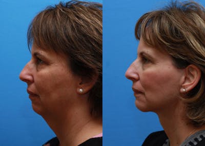 Chin Implants Before & After Gallery - Patient 107116 - Image 1