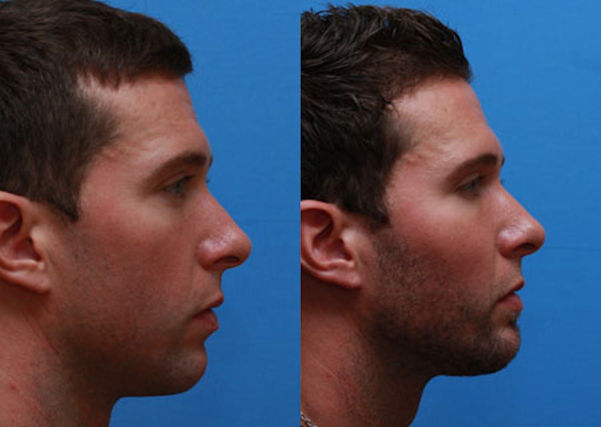 Chin Implants Before & After Gallery - Patient 312752 - Image 1