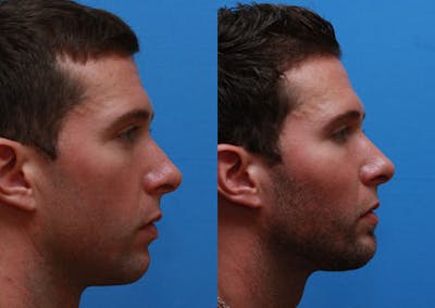 Chin Implants Before & After Gallery - Patient 312752 - Image 1