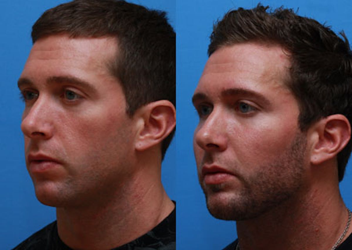 Chin Implants Before & After Gallery - Patient 312752 - Image 2