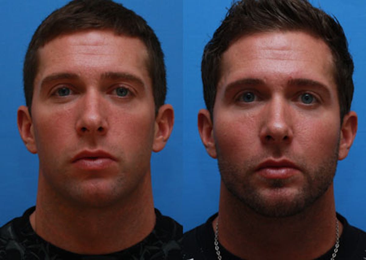 Chin Implants Before & After Gallery - Patient 312752 - Image 3