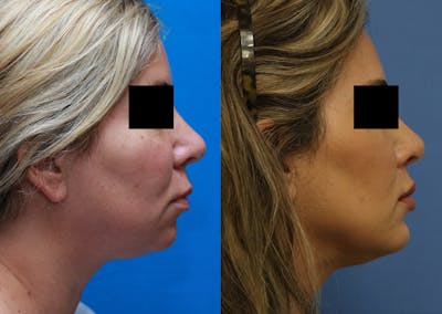 Chin Implants Before & After Gallery - Patient 411598 - Image 1