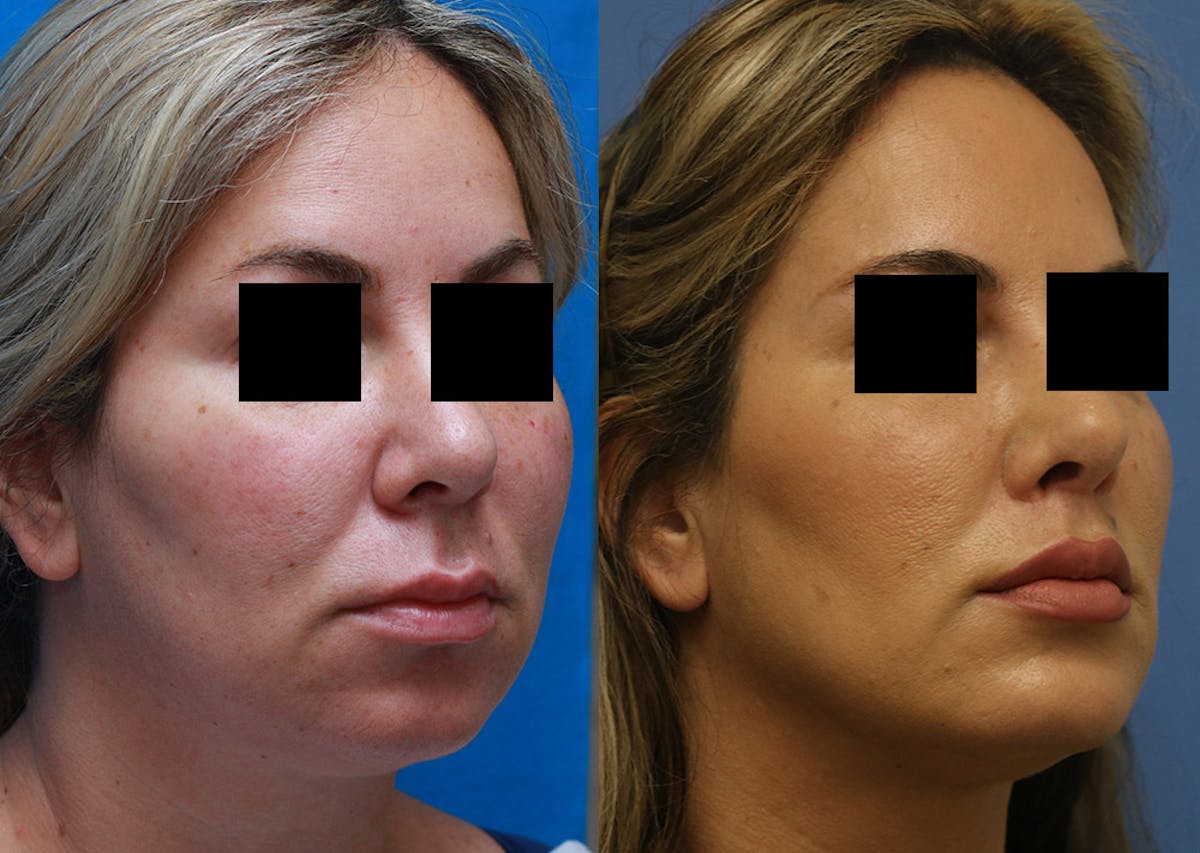 Chin Implants Before & After Gallery - Patient 411598 - Image 2