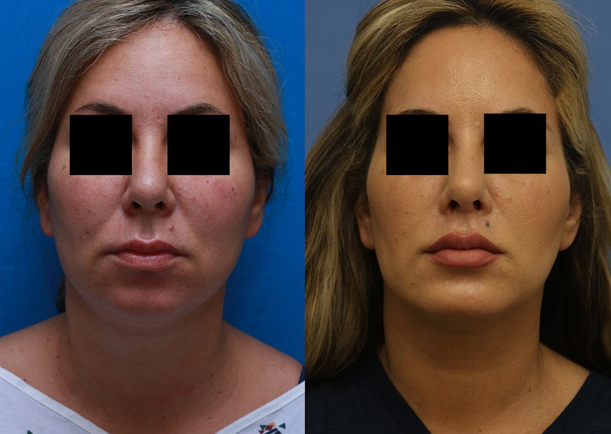 Chin Implants Before & After Gallery - Patient 411598 - Image 3