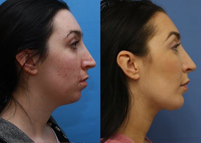 Chin Implants Before & After Gallery - Patient 343129 - Image 1
